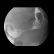 Crohn's disease of small bowel, inflammatory stenosis of the sigmoid colon: RF - Fluoroscopy